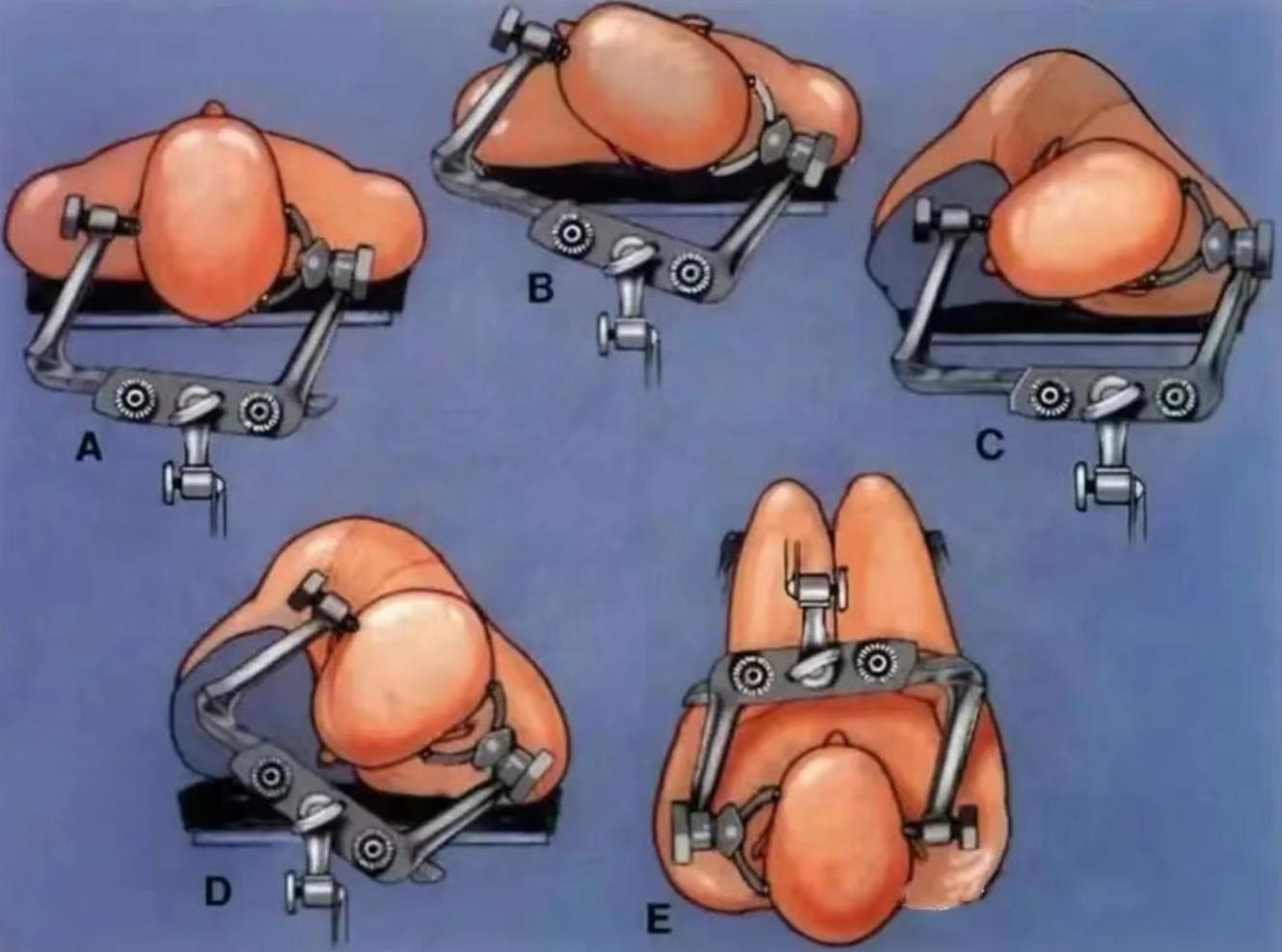 Three-Point Skull Clamp System for Neurosurgery — image 3